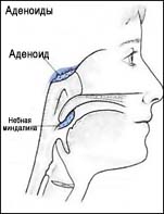 Аденоиды у детей